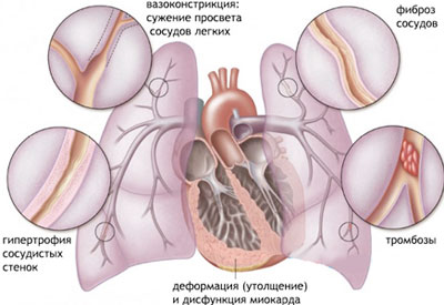 Как лечить пневмофиброз легких