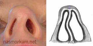 Кривой нос - способы исправить дефект