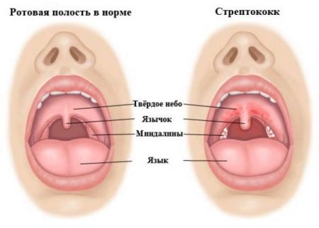 Стрептококковая ангина