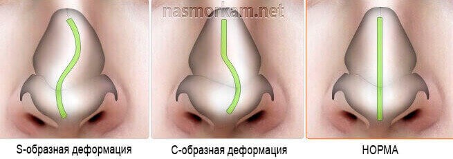 Кривой нос - способы исправить дефект