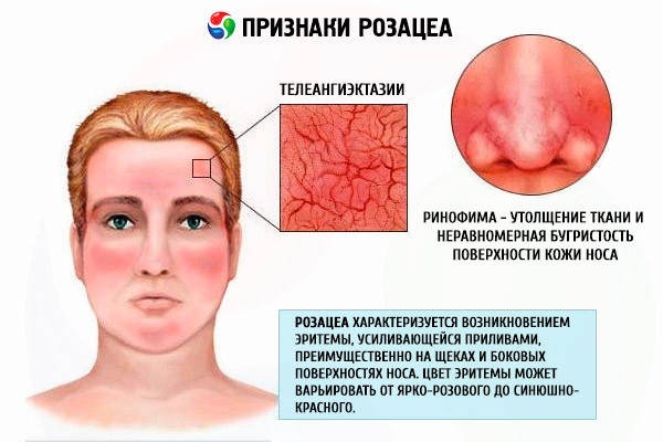 Что делать и как избавиться от покраснения носа