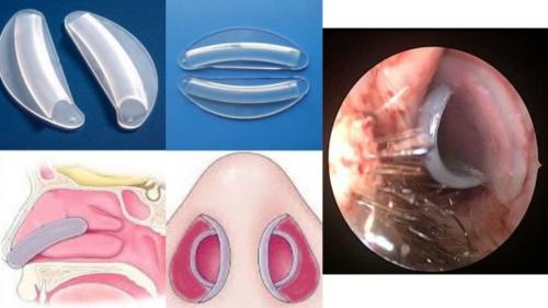 Как избежать проблем с кривой перегородкой носа и как ее можно лечить