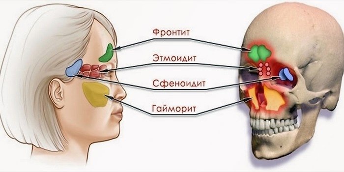 Воспаление придаточных пазух носа