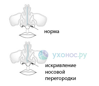 Почему ребенок хрюкает носом, но соплей нет