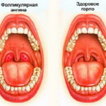 Белые и красные волдыри на задней стенке горла и миндалине