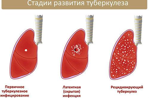 Туберкулез стоит на втором месте после бронхита по проявлению в виде кровохарканья