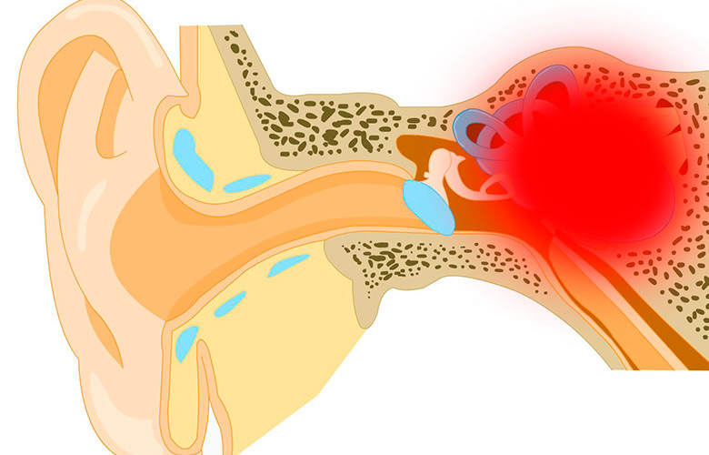 Причины лабиринтита и методы его лечения