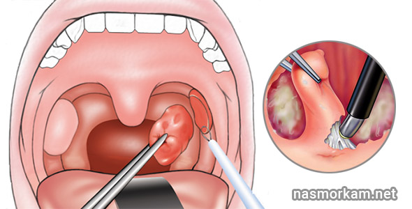 Симптомы тонзиллитных пробок