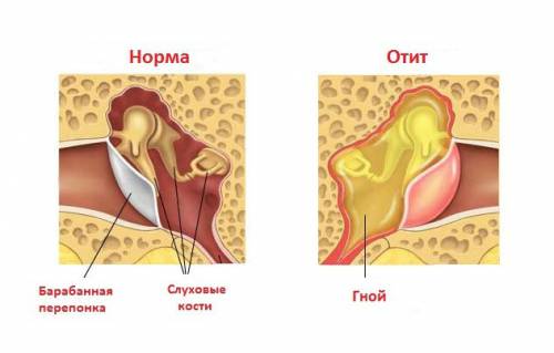 Применение Фурацилинового спирта в ухо