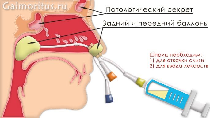 Ямик процедура при гайморите