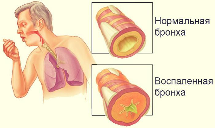 Лечение и профилактика воспаления бронхов