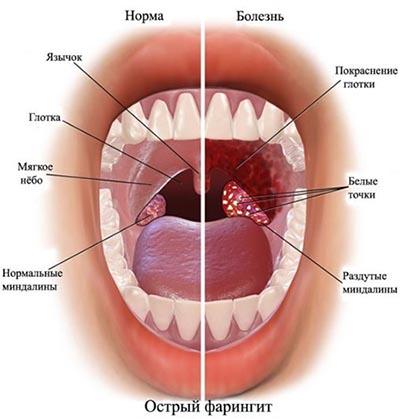 Чем лечить фарингит у взрослых