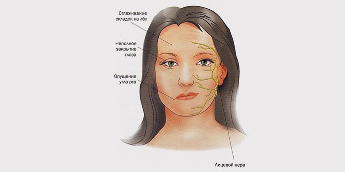 Воспаление тройничного нерва на лице симптомы и лечение