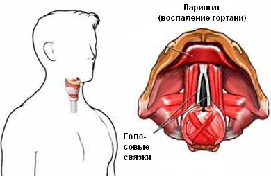 Сильно болит горло больно глотать и разговаривать, чем лечить