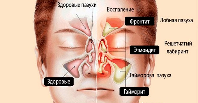 Воспаление придаточных пазух носа