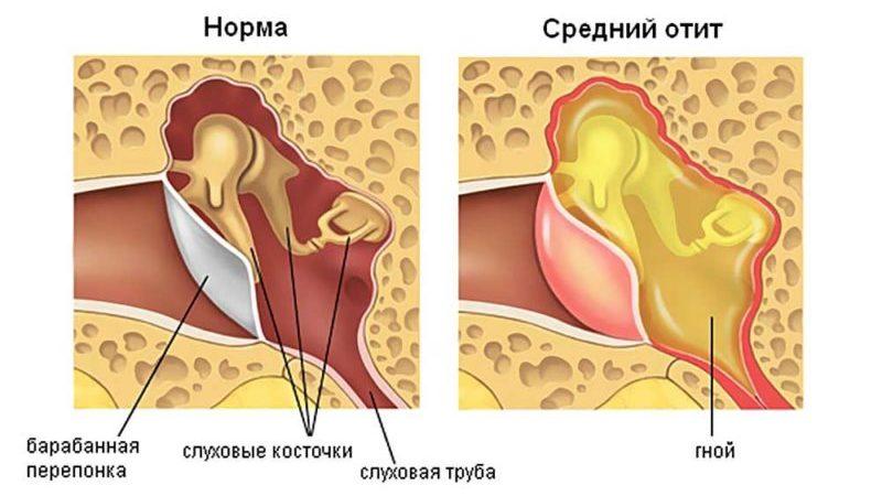 Прокол барабанной перепонки при отите