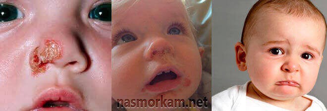 Болячки в носу у ребенка, чем лечить и как