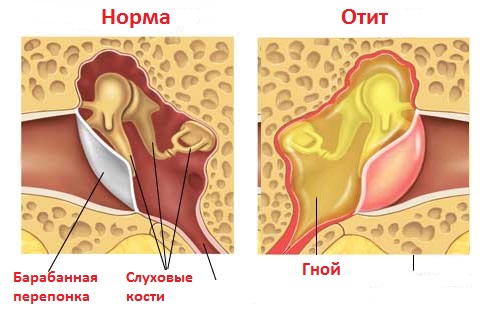 Гнойный отит описание, симптомы и методы лечения