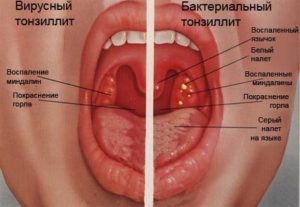 Что делать, если опухли гланды