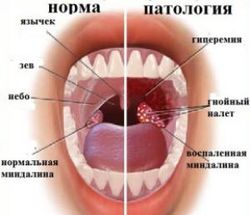 Что делать, если опухли гланды