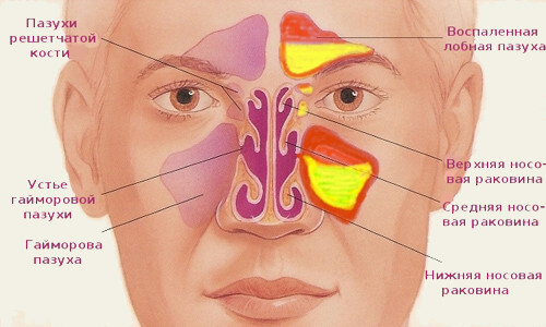 Симптомы и лечение двухстороннего синусита
