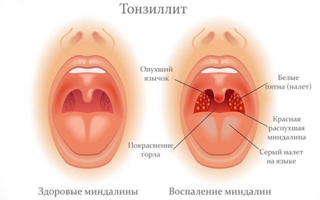 Антибиотики при ангине у ребенка какой лучше, правила применения, обзор препаратов