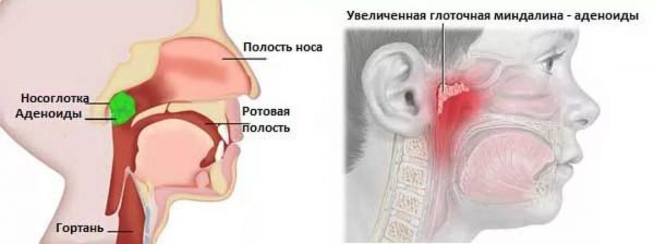 Гипертрофия аденоидов у детей 1, 2 и 3 степени