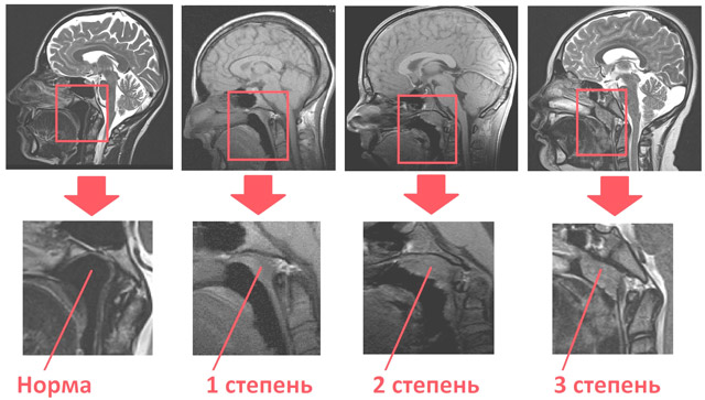 Как лечить аденоиды по методике доктора Комаровского