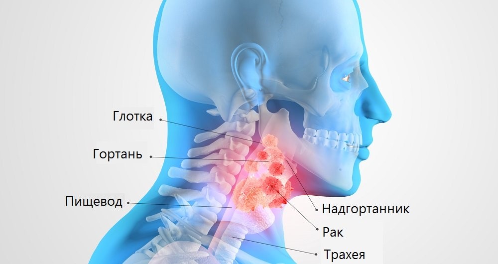 Плоскоклеточный рак гортани