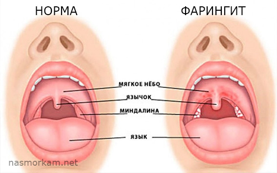 Боль в горле при глотании и кашле слева