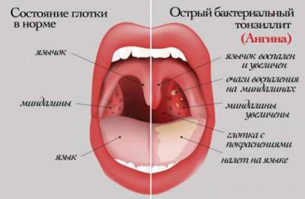 Сиптомы и лечение острого тонзиллита