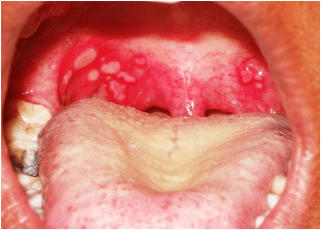 Белые и красные волдыри на задней стенке горла и миндалине