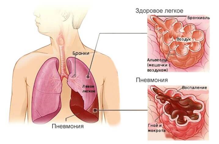 Свистящее дыхание и его лечение