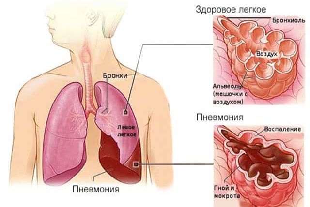 Лечение микоплазменной пневмонии