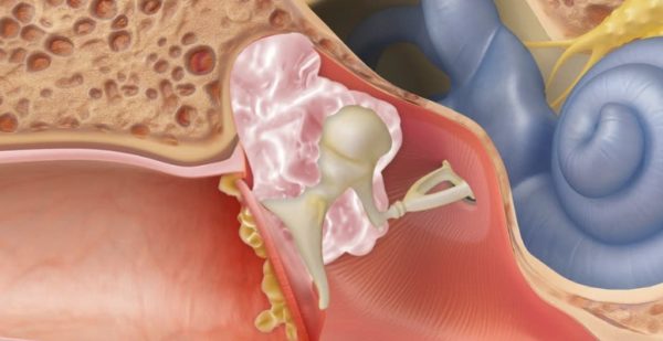 Признаки, осложнения и методы лечения холестеатомы уха