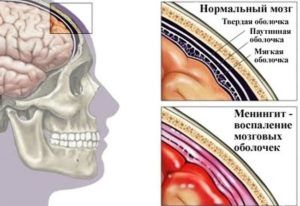 Околоносовые пазухи пневматизированы что это значит