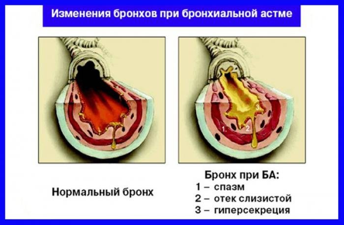 Причины и симптомы болезней легких у человека