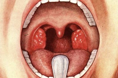 Особенности лечения бактериального тонзиллита