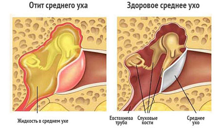 Острый средний отит лечение