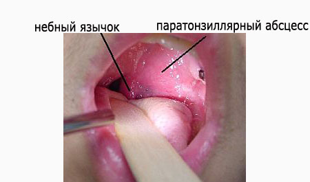 фото симптомов паратонзиллярного абсцесса