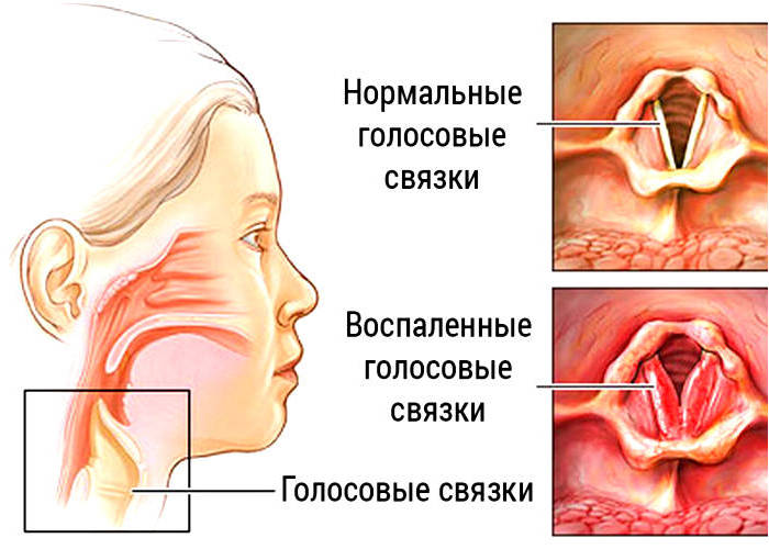 Как и чем лечить воспаление голосовых связок причины и профилактика недуга