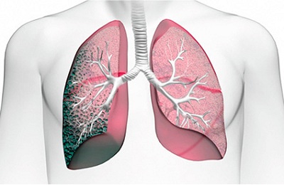 Как лечить пневмофиброз легких