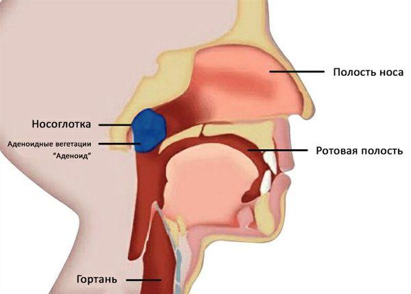 Методы лечения аденоидов у взрослых