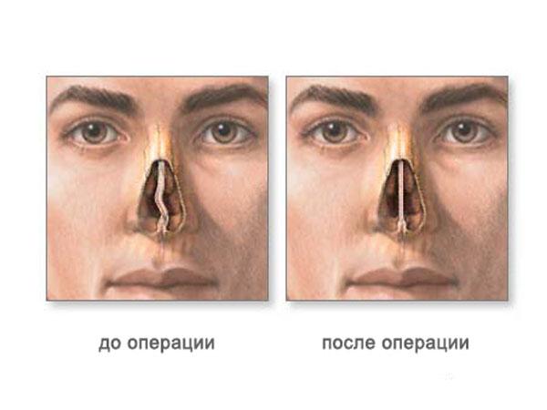 Виды операций септопластики носовой перегородки