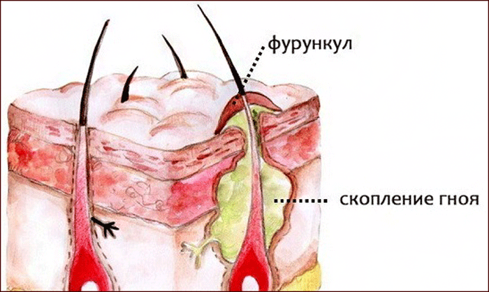 Шарик или шишка в мочке уха