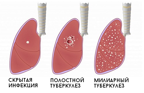 Терапия приступообразного кашля у взрослых