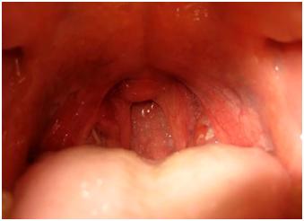 Симптомы и лечение острого тонзиллита у ребенка