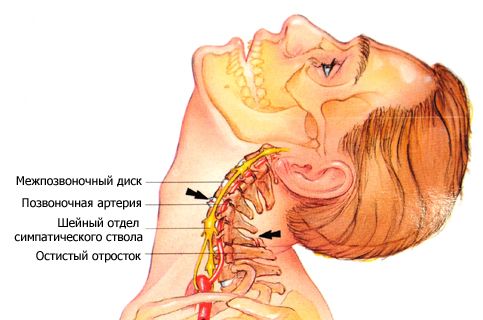 Является ли остеохондроз причиной отеков шейных позвонков