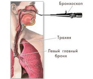 Как развивается обструктивный бронхит у взрослых