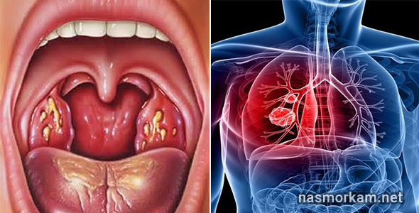 Чем лечить боль в горле при глотании